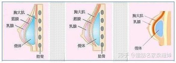 隆胸有哪几种方式，隆胸哪种方式比较好呀 