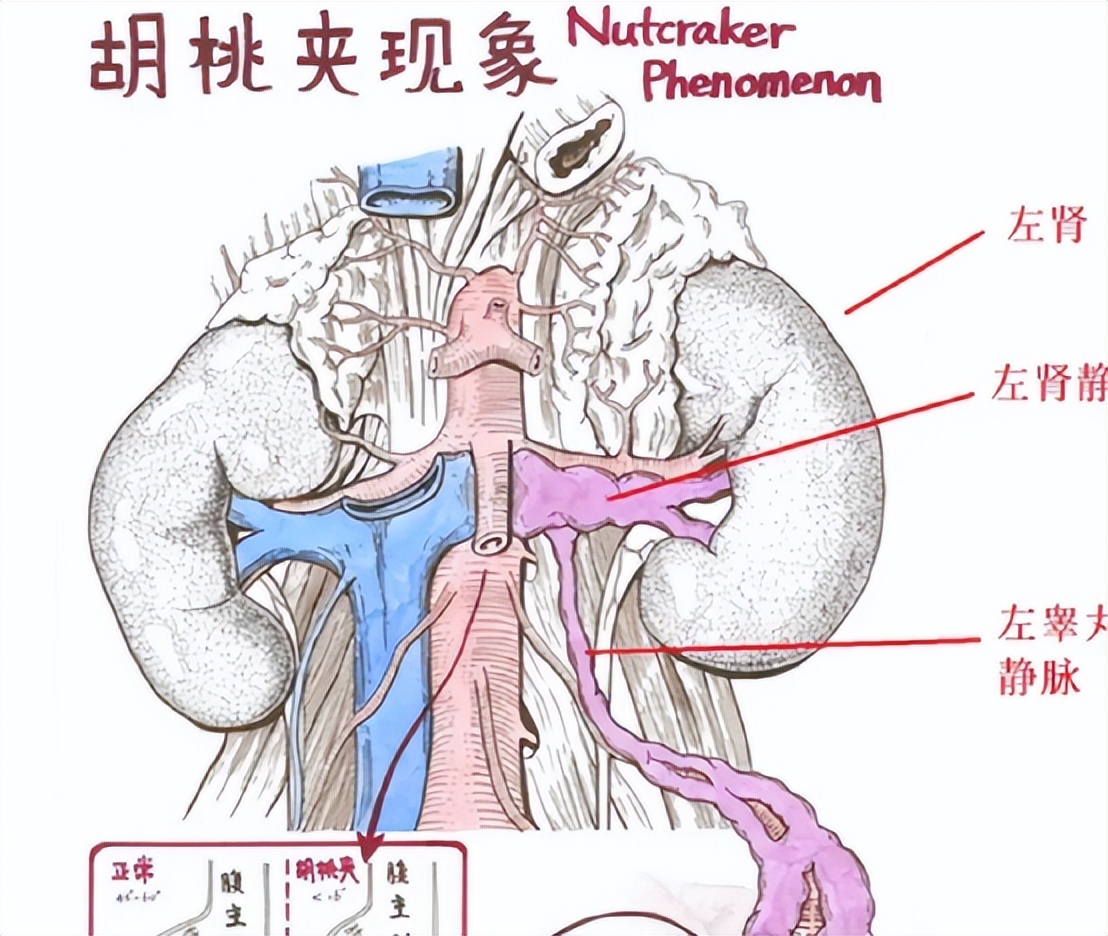 胡桃夹是什么意思，胡桃夹综合征引起的原因 